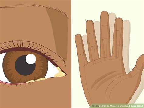 How To Clear A Blocked Tear Duct 12 Steps With Pictures