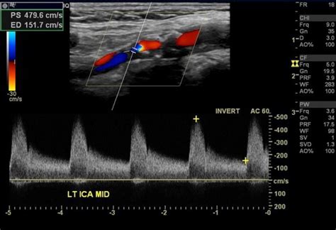 Carotid Doppler Scan – Earth's Lab