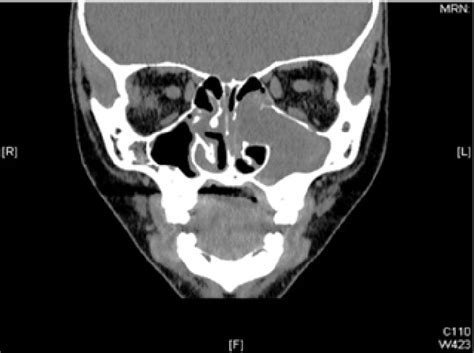 Figure From A Rare Case Of Cavernous Hemangioma Of Maxillary Sinus