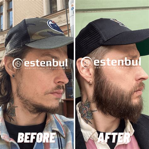 Beard And Moustache Transplant In Turkey Estenbul Health