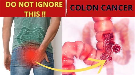 Top 6 Warning Signs Of Colon Cancer Colorectal Cancer Symptoms You