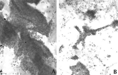 Figure 1 From Fine Needle Aspiration Cytologic Features Of Mammary