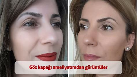 Göz kapağı ameliyatımdan görüntüler İyileşme süreci Dr Akın Banaz YouTube