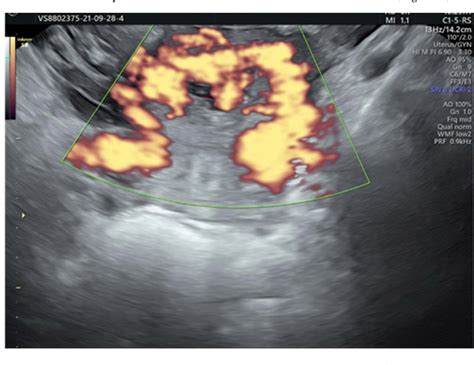 Figure 4 From Retained Placenta Percreta With Acquired Uterine Arteriovenous Malformation—case