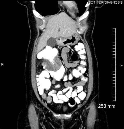 Colocolic Intussusception Due To Mucinous Carcinoma Of The Colon