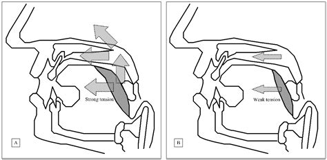 Combined Transoral Robotic Tongue Base Surgery and Palate Surgery in Obstructive Sleep Apnea