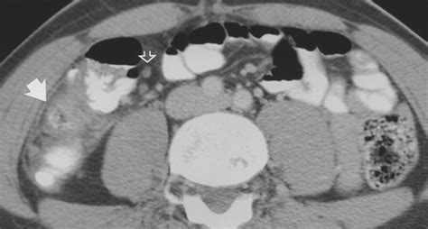 Mesenteric Adenitis Ct Diagnosis Of Primary Versus Secondary Causes Incidence And Clinical