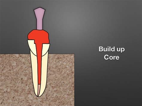 Custom post & core ( lab procedure)