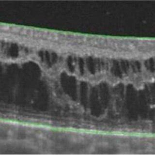 A And B Structural Optical Coherence Tomographic Oct Scan Of The