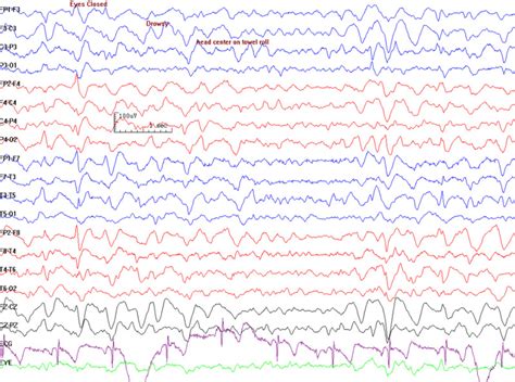 Figure Triphasic Waves Contributed By Prabhu Emmady Md Statpearls