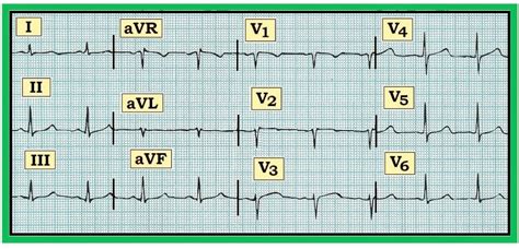 ECG Interpretation: ECG Interpretation Review #82 (Acute STEMI – RCA ...