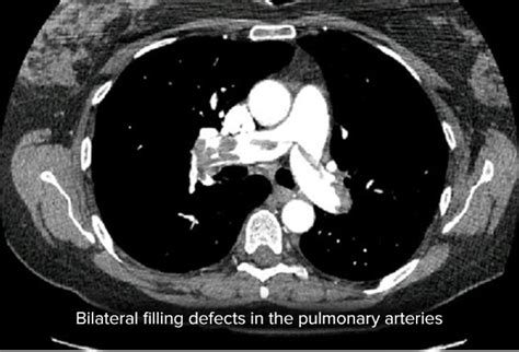 Pulmonary Embolism Clot In Transit