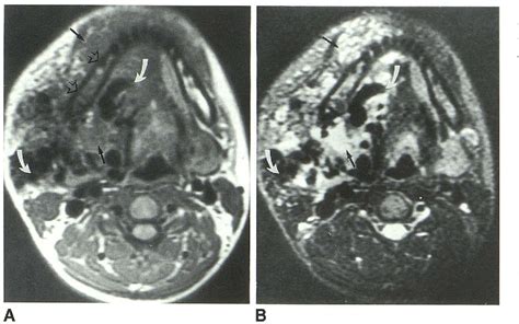 Figure 1 From Head And Neck Mr Characterization Hemangiomas And