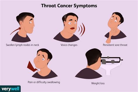 Throat Cancer: Signs and Symptoms