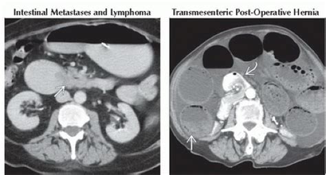 Da Db Small Bowel Obstruction Ffu Abdominal Key