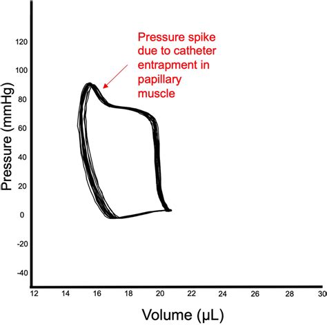 Catheter Entrapment Example Of Entrapment Of Catheter In Papillary