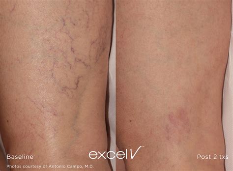 Excel V Laser Vascular Lesion Treatment Beverly Hills Los Angeles Ca