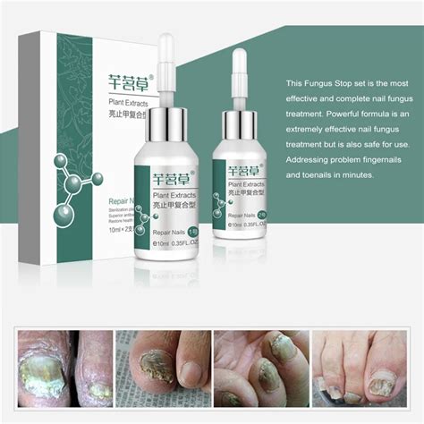 2*10ml Nail Fungus Treatment Set Fungus Stop Anti Fungal Nail Infection ...