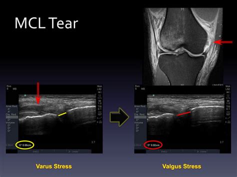 Ultrasound - Knee