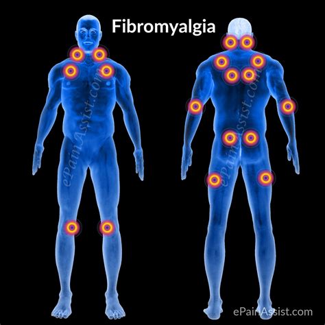 FAQ on Fibromyalgia|Symptoms|11 Painful Trigger Points|Causes|Risk Factors