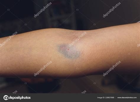 Bruises From Blood Collection Isolated Purple Bruise On The Arm