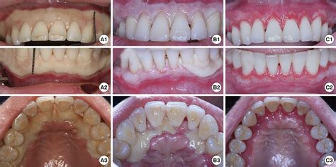 Extensive Gingival Necrosis And Sequestration Of The Alveolar Bone