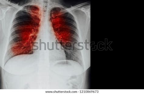 Pulmonary Tuberculosis Tb Chest Xray Show Stock Photo Edit Now 1210869673