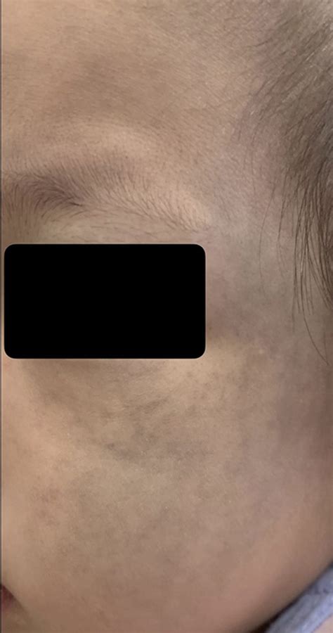 Nevus Of Ota Ark Dermatology