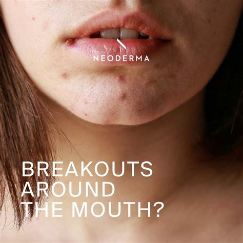 how to get rid of breakouts around mouth