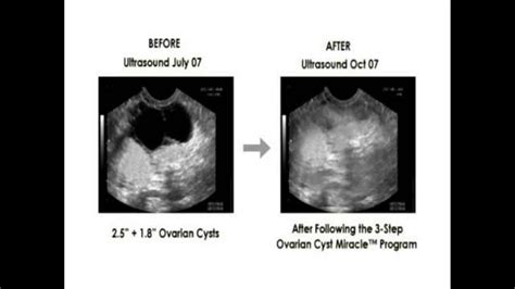 Ovarian Cyst Warning Signs