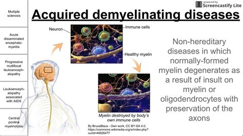 Acquired demyelinating diseases - YouTube