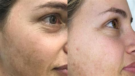 Microagulhamento Para Melasma Veja Como Funciona