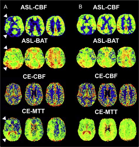 Multi Slice Asl And Ce Perfusion Maps Of A Patient With Right Sided Ica