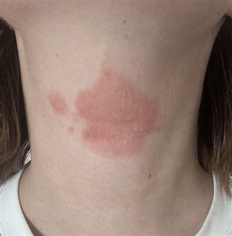 Any tips for neck eczema? : r/EczemaUK