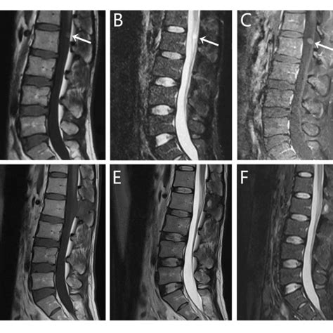 Radiographic Images Of Case A C Pre And D F Postoperative