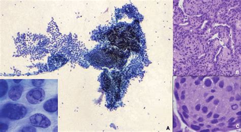 30 Papillary thyroid carcinoma, cribriform-morular variant. (a) The ...