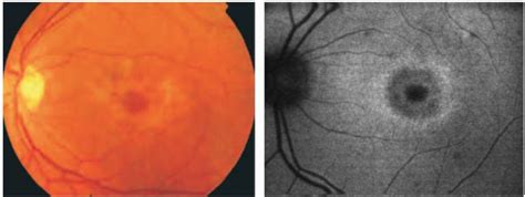 Fundus Autofluorescence In Cone And Cone Rod Dystrophies Ento Key