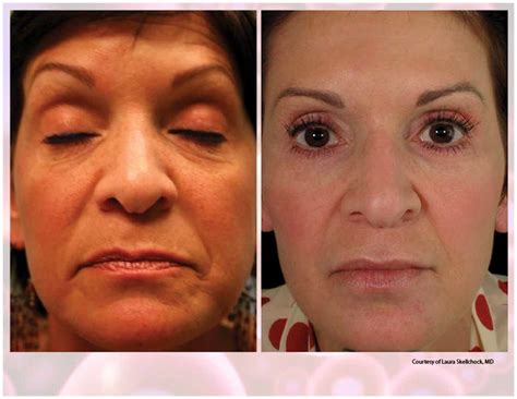 Prp Facial Treatment Before And After