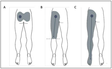 Si Joint Pain Referral Patterns