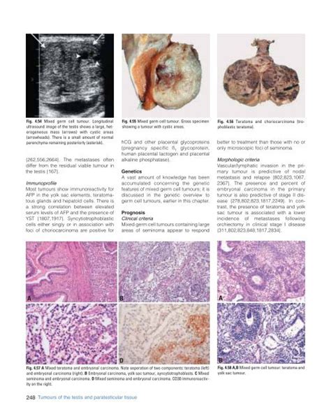 Abfig Teratoma With