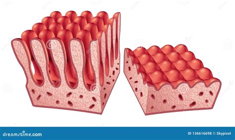 Coeliac Disease Or Celiac Disease Small Bowel Showing Coeliac D Vector