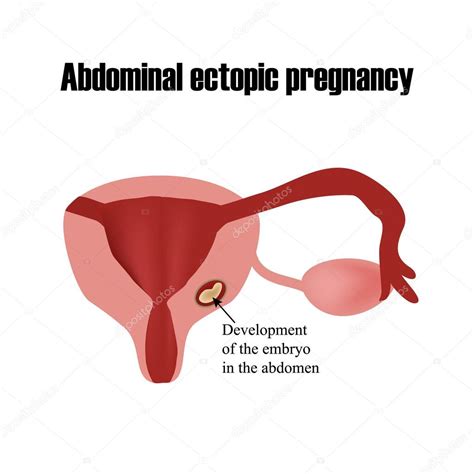 Desarrollo del embrión en el abdomen Embarazo ectópico Infografías