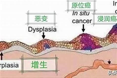 原位癌是什么意思 原位癌是什么意思 能治愈吗 热点百科 山东研几周易文化传播有限公司