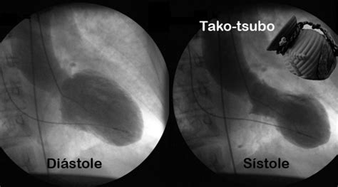 Sindrome De Takotsubo