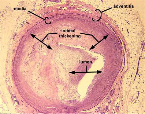 memorandum atherosclerosis elastin stain