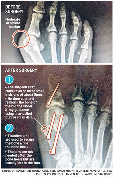 Sgh Doctor On New Minimally Invasive Bunion Surgery Healthxchange