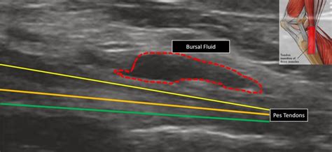 Pes Anserine Bursitis: Causes, Symptoms, & Treatment