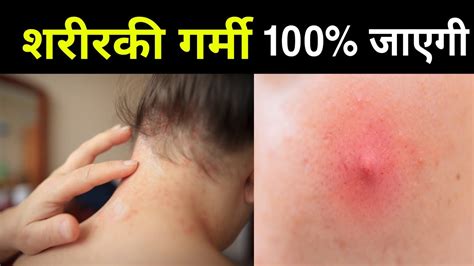 Pet Ki Garmi Ka Ilaj Homeopathic L Garmi Ke Lakshan L Symptoms Of Body