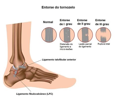 Aprenda A Tratar Uma Entorse De Tornozelo Em Casa Educar Sa De