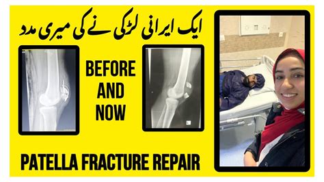 After 1 Year Knee Surgery Alhamdulillah Finally Recover Patella Fracture Repair Habib3211